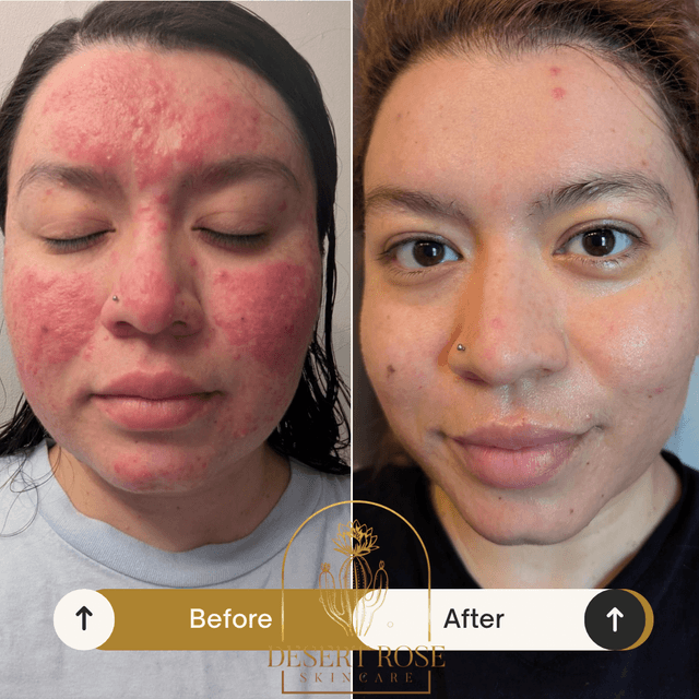 The Clear Skin Blueprint at Desert Rose Skincare in Rio Rancho, NM